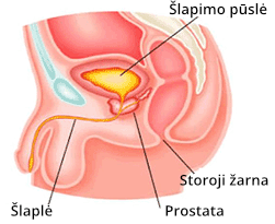 Prostata Prostatos liaukos iliustracija